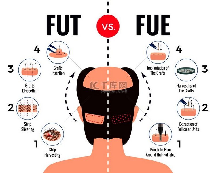 毛发移植方法 fut vs f