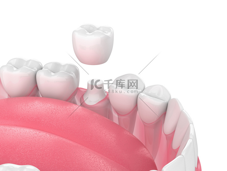 3d. 用牙齿和牙冠修复颌骨的渲染