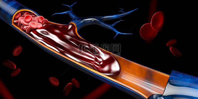 深静脉血栓或血凝块的 3d 插图。