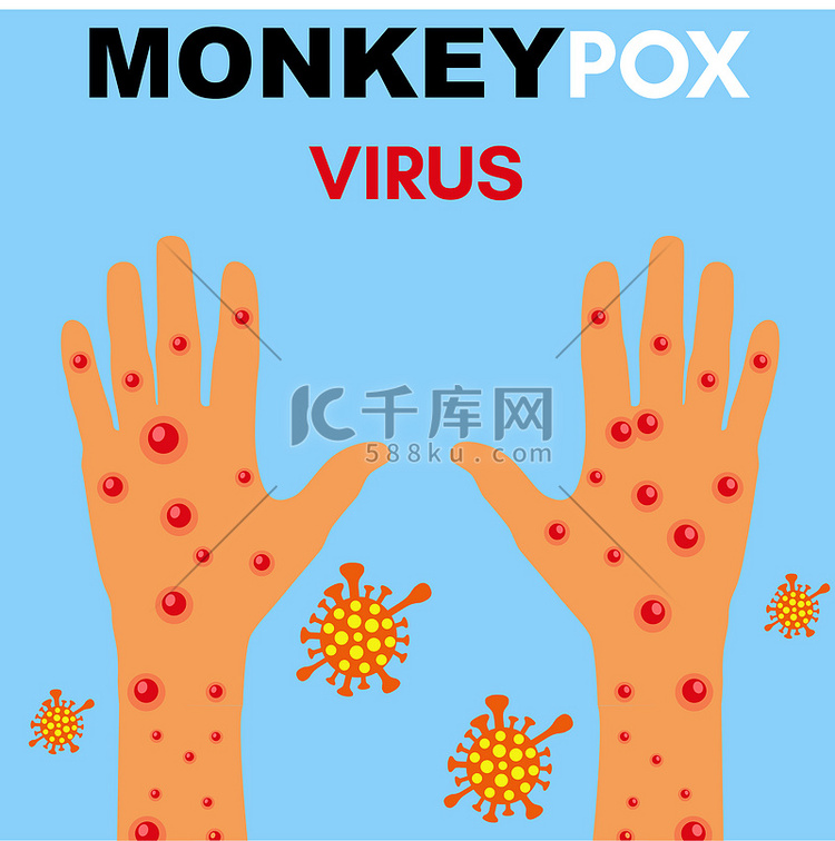 猴痘病毒插图，猴痘手载体，猴痘