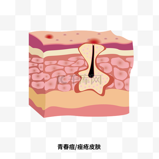 青春痘皮肤状态问题立体剖面图图片