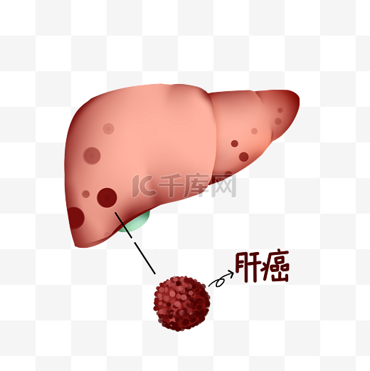 人体内脏肝癌肝脏医疗疾病图片
