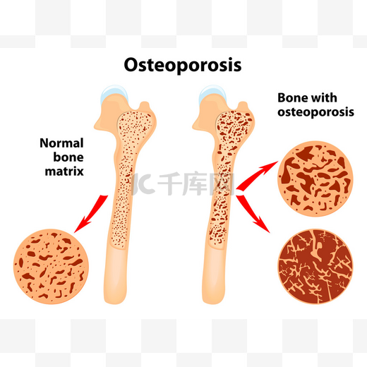 Osteoporosis图片