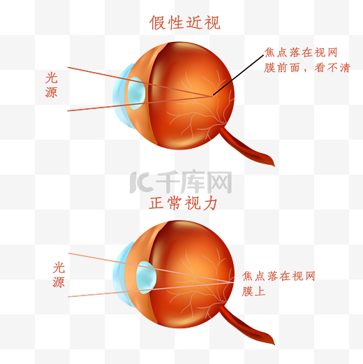 假性近视图片