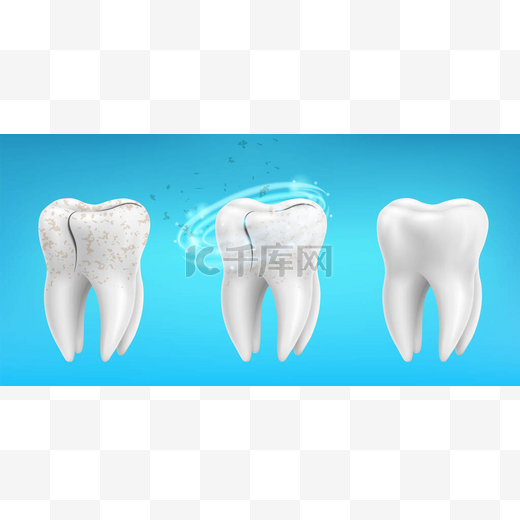 3d realistic clean and dirty tooth set on blue background, Teeth cleaning and whitening procedure. Dental health concept. Healthy enamel. Vector illustration.图片