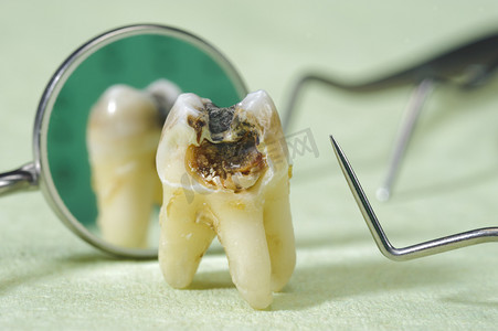 蛀的牙齿龋齿局部放大特写