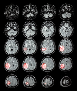 磁共振脑: 在右顶叶脑肿瘤