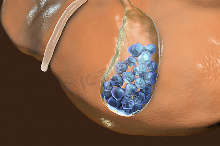 胆结石，插图显示底部视图的肝脏和胆囊结石