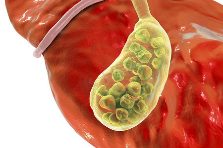 底部通知栏摄影照片_胆结石，插图显示底部视图的肝脏和胆囊结石