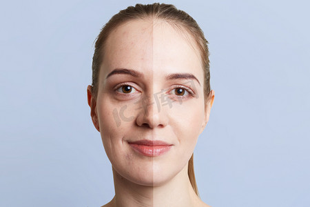 特写女性脸上的肖像分为两部分: 健康的纯皮肤和不健康的黑头, 两种皮肤的对比。面部护理、美容、医学和美容理念