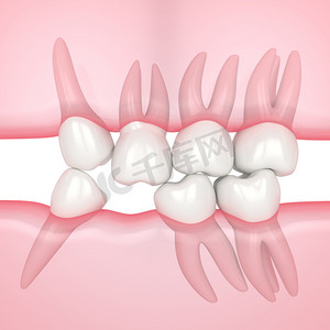 三维渲染的牙齿滑向缺牙区域，以填补缺口。牙齿丢失较少的后果.