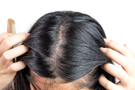 女性头上有头皮屑造成的肮脏问题。或皮肤疾病或脂溢性皮炎引起的。它有白色鳞片, 它会引起瘙痒.