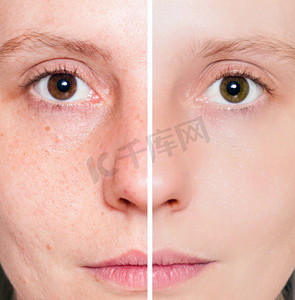 皮肤斑点摄影照片_女人与深层毛孔和黑头斑点皮肤和愈合的软皮