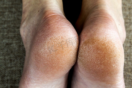 躺在床上摄影照片_躺在床上的女人脚干燥开裂的皮肤。足部护理.