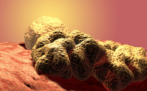癌症细胞肿瘤，3d 医学插图