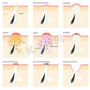 acne formation process