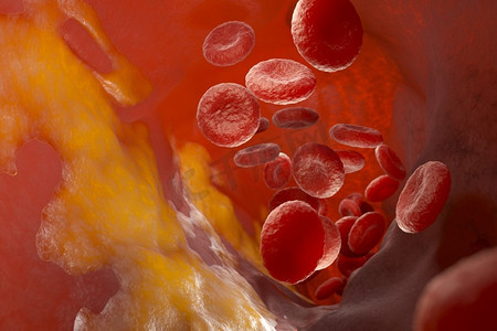 动脉胆固醇斑块，血管内有流动的血细胞。3D插图。动脉胆固醇斑块