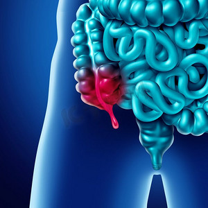 阑尾疼痛和阑尾炎炎症疾病的概念作为人体肠道解剖的特写，作为3D插图。