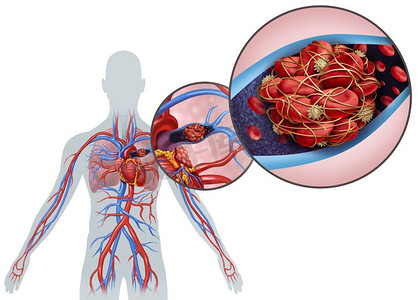 肺栓塞与血凝块作为疾病与动脉阻塞在肺与3D例证元素。