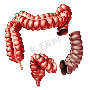 结肠切除术，结肠外科手术，切除大肠的一部分，作为3D肠管。