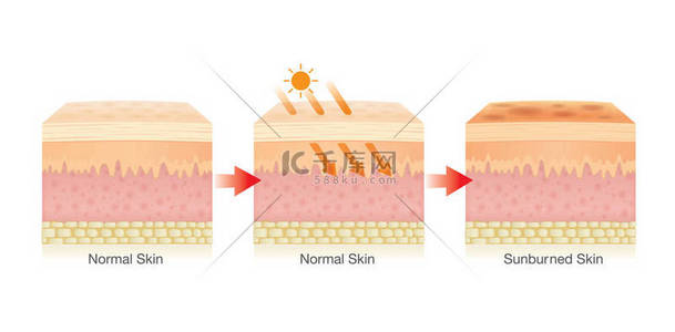 一步的变化与人类皮肤层损坏从阳光.