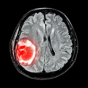 MRI 大脑：显示大脑右顶叶的脑肿瘤