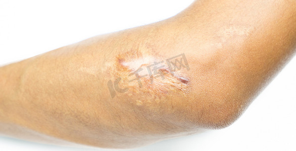 在白色背景和复制空间的摩托车事故后，亚洲男性皮肤手肘上的特写瘢痕疙瘩疤痕。