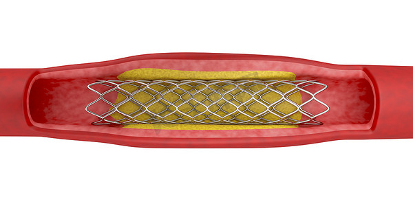 气球摄影照片_带支架置入术的血管成形术