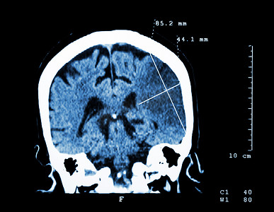 脑卒中摄影照片_左半球脑梗塞（缺血性中风）（大脑 CT 扫描）：医学和科学背景