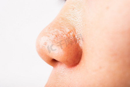 女性毛孔粗大，脸上有雀斑脸颊油腻，鼻子上长粉刺
