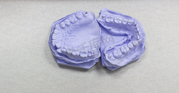 在正畸医生处用石膏制成的牙齿石膏模型。
