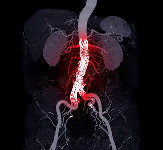 CTA 全主动脉与腹主动脉覆膜支架比较 3D 渲染图像。