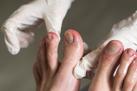 一个男人的脚趾显示出看起来像皮疹和红色斑点的皮肤。 