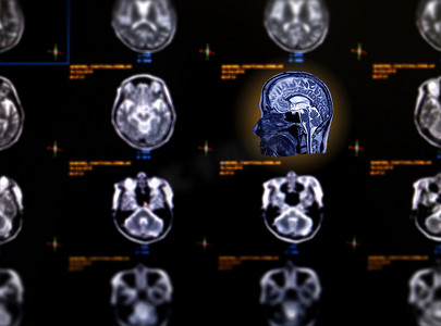 MRI 脑轴向视图的选择性聚焦，用于检测脑卒中疾病的各种情况。