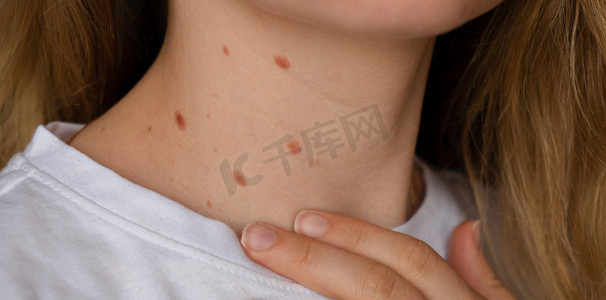 无法辨认的女人在颈部皮肤上显示她的胎记 特写裸露皮肤的细节 阳光照射对皮肤的影响，紫外线辐射对健康的影响 有胎记的女人 色素沉着