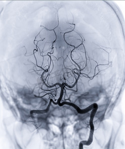 脑血管造影 imageor 大脑后动脉从荧光镜检查在显示基底动脉的介入放射学中。