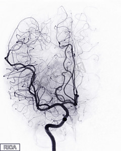 介入放射学中透视的脑血管造影图像显示脑动脉。