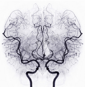 介入放射学中透视的脑血管造影图像显示脑动脉。