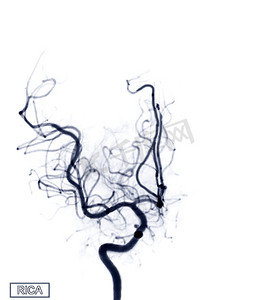 RICA 的脑血管造影图像在介入放射学中显示脑动脉。