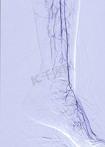 动脉瘤摄影照片_股动脉血管造影或下肢区域血管造影。