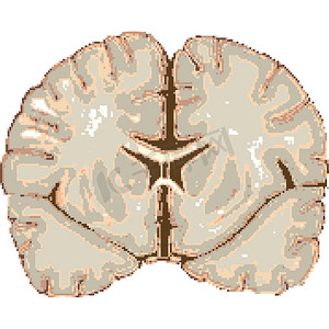 动脉瘤摄影照片_人脑被白色隔离
