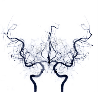 介入放射学中透视的脑血管造影图像显示脑动脉。