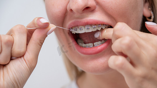 白种女人用牙线清洁她戴着牙套的牙齿。