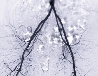 股动脉血管造影或血管造影