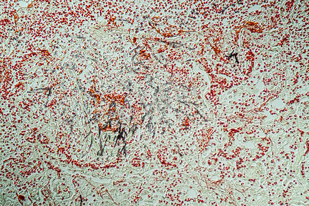 曲霉菌摄影照片_艾滋病患者肺部念珠菌和曲霉菌感染 20