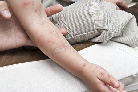 孩子手臂上的疱疹。
