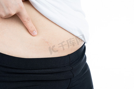 显示在她的腹部的妇女特写镜头从在白色背景隔绝的阑尾炎手术。