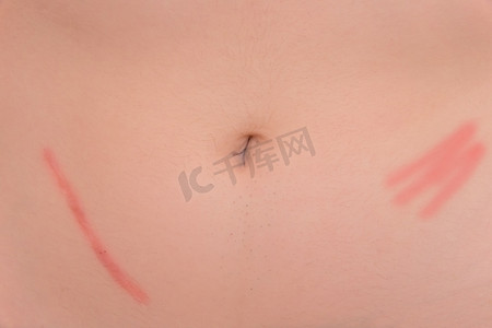 阑尾炎摄影照片_切除阑尾炎手术后的身体腹部皮肤疤痕手术后果，特写