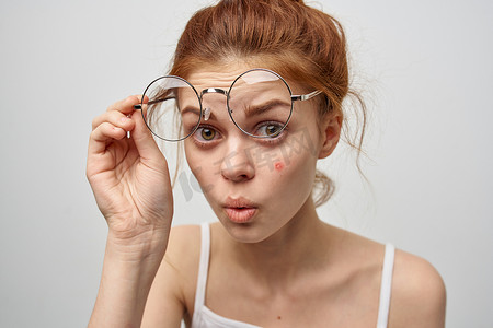 红发摄影照片_戴眼镜的红发女人脸上有痘痘皮肤科皮肤护理