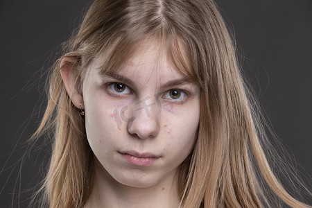 一个十几岁的女孩脸上长着粉刺，特写是灰色的。